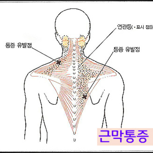 근막통증증후군에 걸린 것 같다.